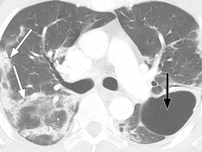 Figure 6 Patient with COVID-19. Chest CT 20 days after symptom onset shows bilateral opacities with peripheral and&hellip;