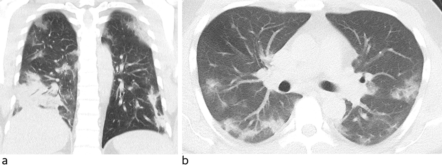Figur 1 Lavdose CT thorax, med koronalt snitt (a) og aksialt snitt (b). Bildene viser rikelig med diffust avgrensede&hellip;