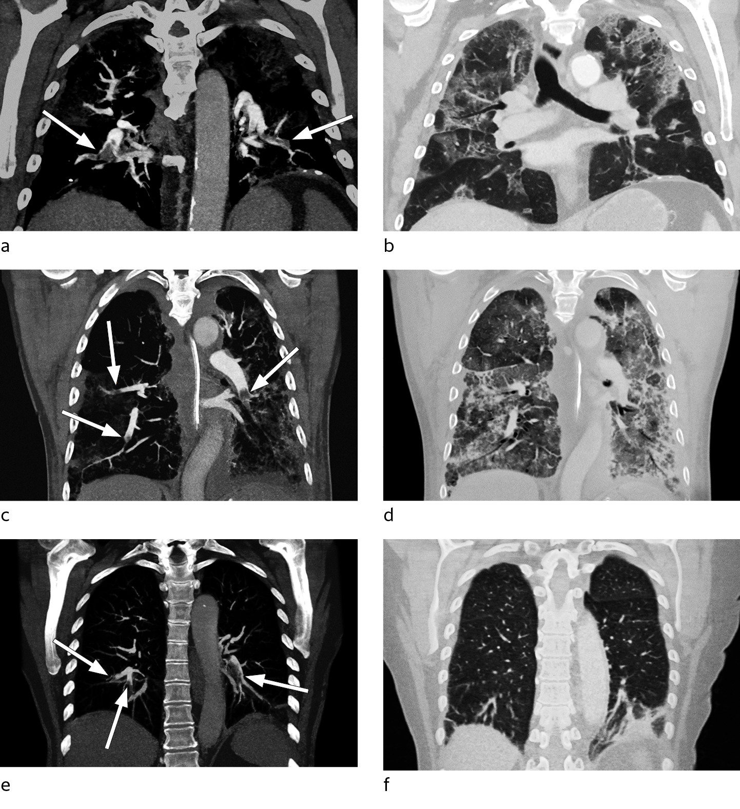 Figur 2 CT pulmonal angiografi med koronale MIP-rekonstruksjoner (maksimal intensitetsprojeksjon). Bildene viser&hellip;