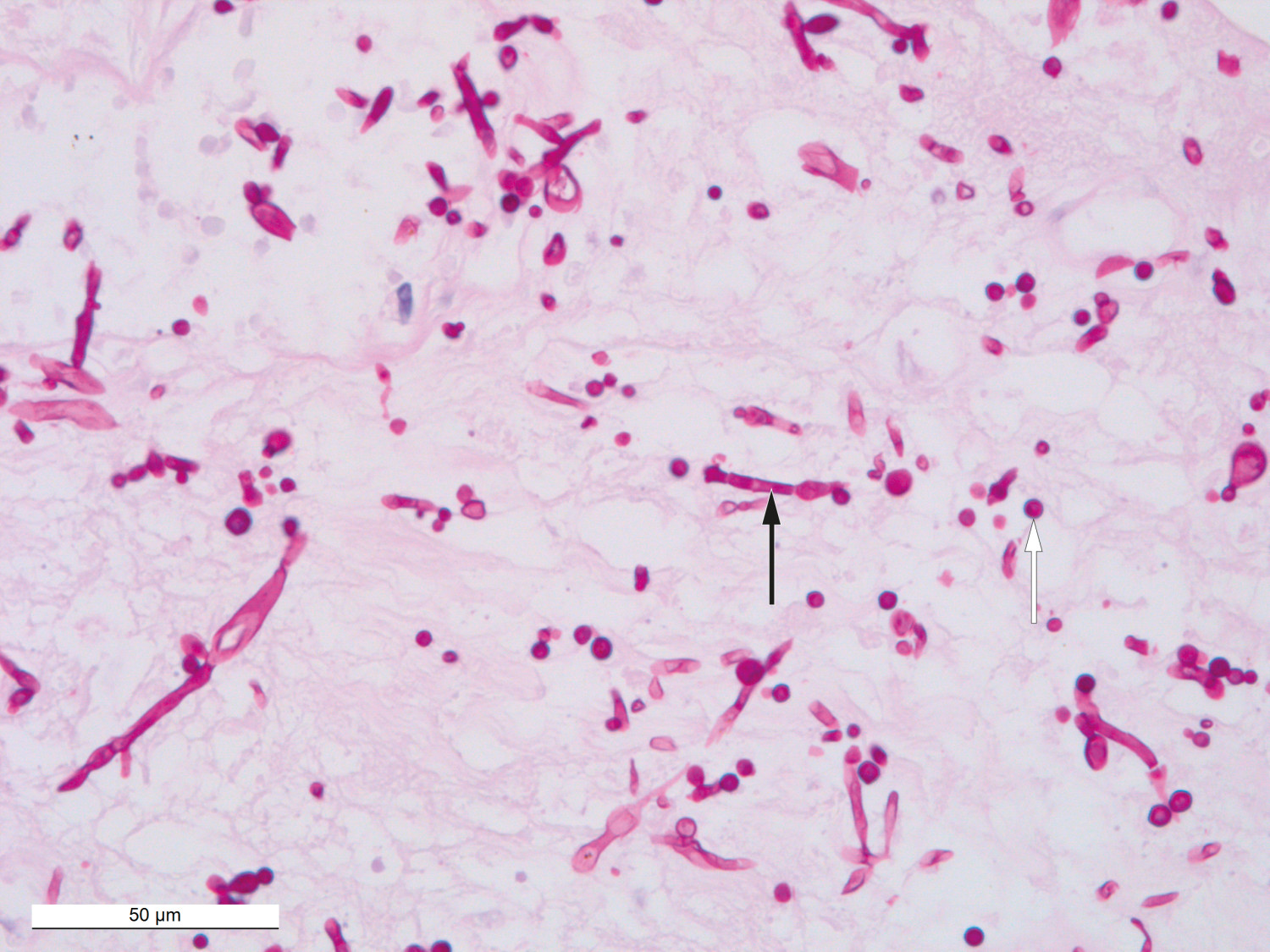 Figur 2 Histologisk PAS-farget snitt av vev fra s&aring;rkant p&aring; h&oslash;yre kne viser positive sopphyfer (sort pil) og sporer (hvit pil&hellip;