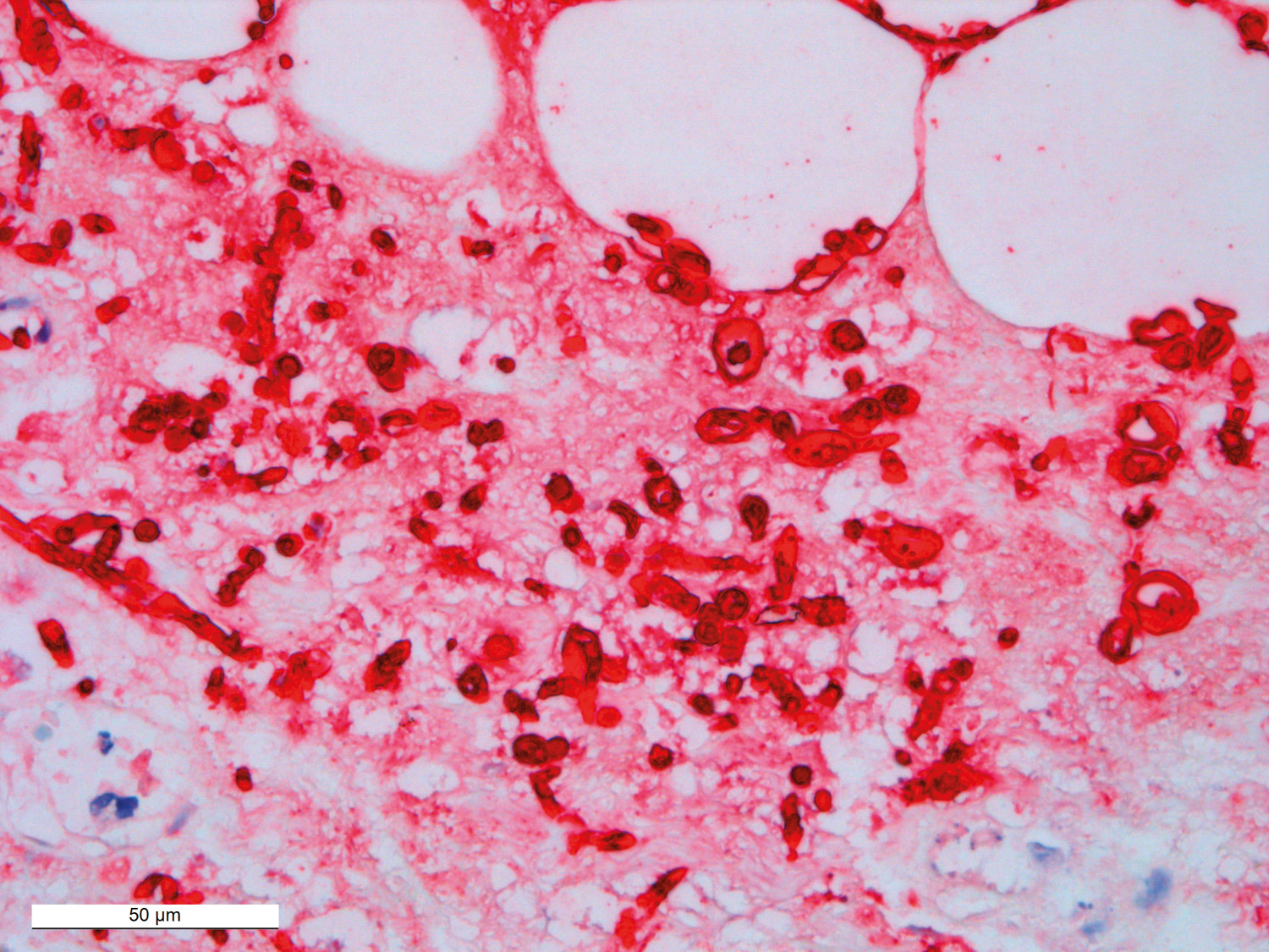 Figur 3 Immunhistokjemisk unders&oslash;kelse viser positivitet (r&oslash;dt) for Candida.