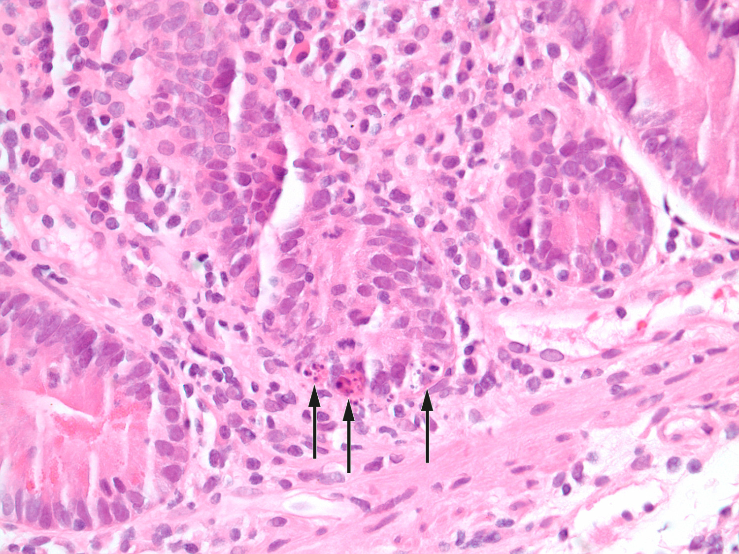 Figur 2 Hematoksylin- og eosinfarget duodenalbiopsi med &oslash;kt antall betennelsesceller i lamina propria, apoptoser i&hellip;