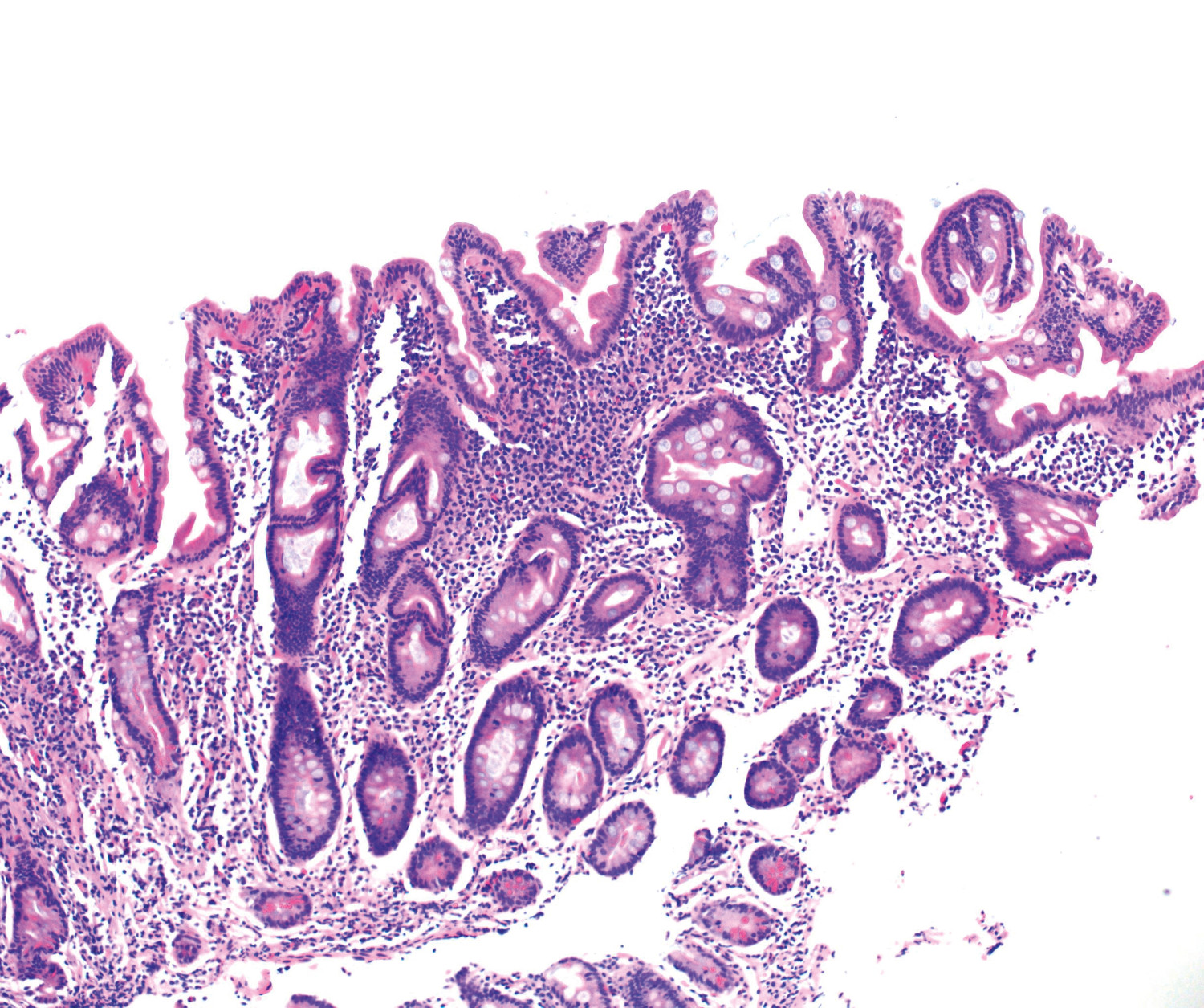 Figur 3 Hematoksylin- og eosinfarget duodenalbiopsi. Regenererte tarmtotter etter behandling og lavere grad av&hellip;