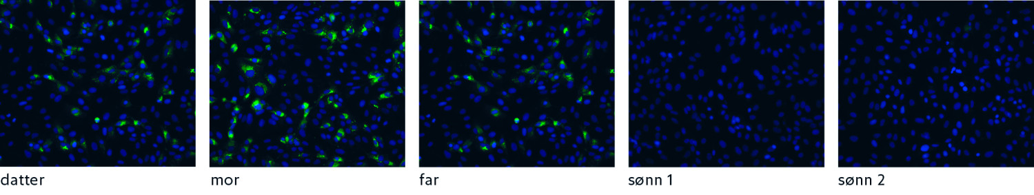 Figur 2 Immunfluorescensfarging (IF) av sars-CoV-2-infiserte celler med serum fra alle fem i familien. Sars-CoV-2-spesifikt&hellip;