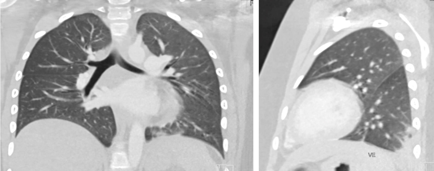 Figur 2 CT thorax med intraven&oslash;st kontrastrastmiddel viser en basal fortetning og beskjedne mattglassfortetninger i venstre&hellip;