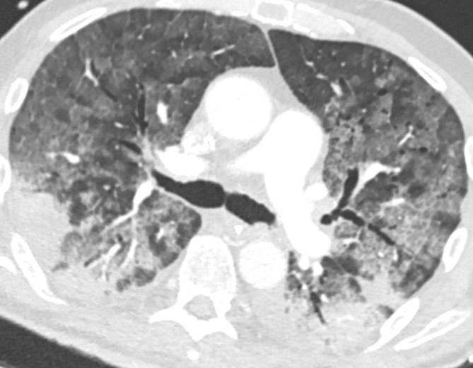 Figur 2 CT thorax (aksiale snitt) tatt dag 15 viser uttalt mosaikkm&oslash;nster med matglassforandringer i begge lunger.