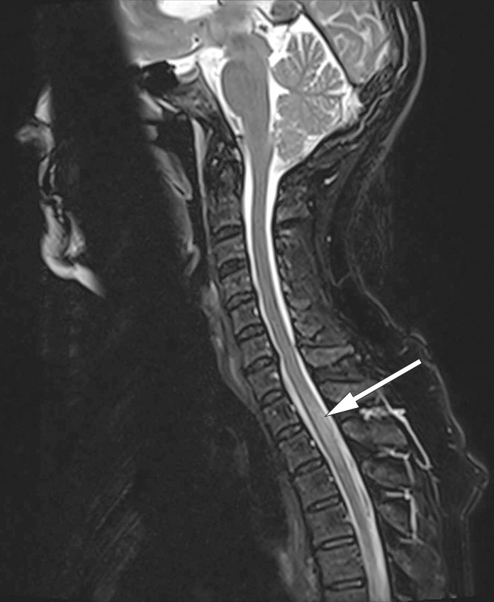 Figur 2 MR av cervikalcolumna. Sagittal T2-vektet sekvens avdekker nytilkomne h&oslash;ysignalforandringer i niv&aring; Th1&ndash;Th3.
