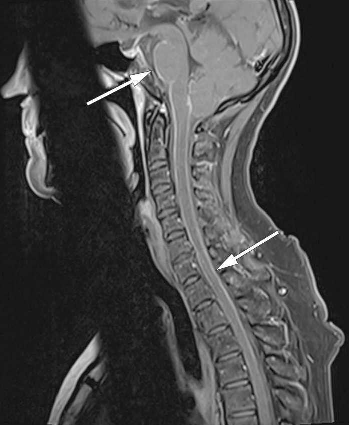 Figur 3 MR av cervikalcolumna. Sagittal T1-vektet sekvens med fettsuppresjon etter kontrasttilf&oslash;rsel avdekker markert&hellip;