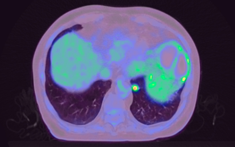 Figur 3 &Oslash;kt FDG-opptak i tumor medialt og basalt i venstre lunges underlapp ved FDG-PET/CT tatt under siste innleggelse.
