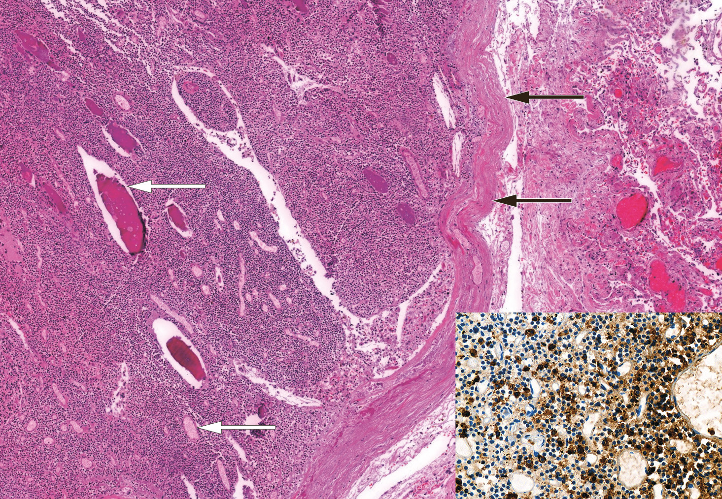 Figur 4 Hematoksylin- og eosinfarget histologisk snitt fra lunge ved obduksjon viser lungevev med en velavgrenset,&hellip;