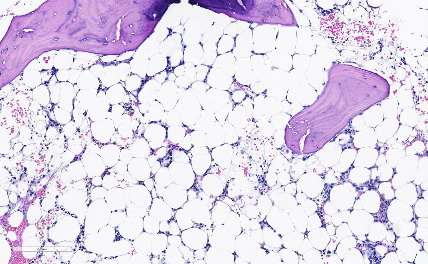 Figur 2 Sterkt hypocellul&aelig;r benmarg hos en pasient med veldig alvorlig aplastisk anemi. Her sees ingen organisert&hellip;