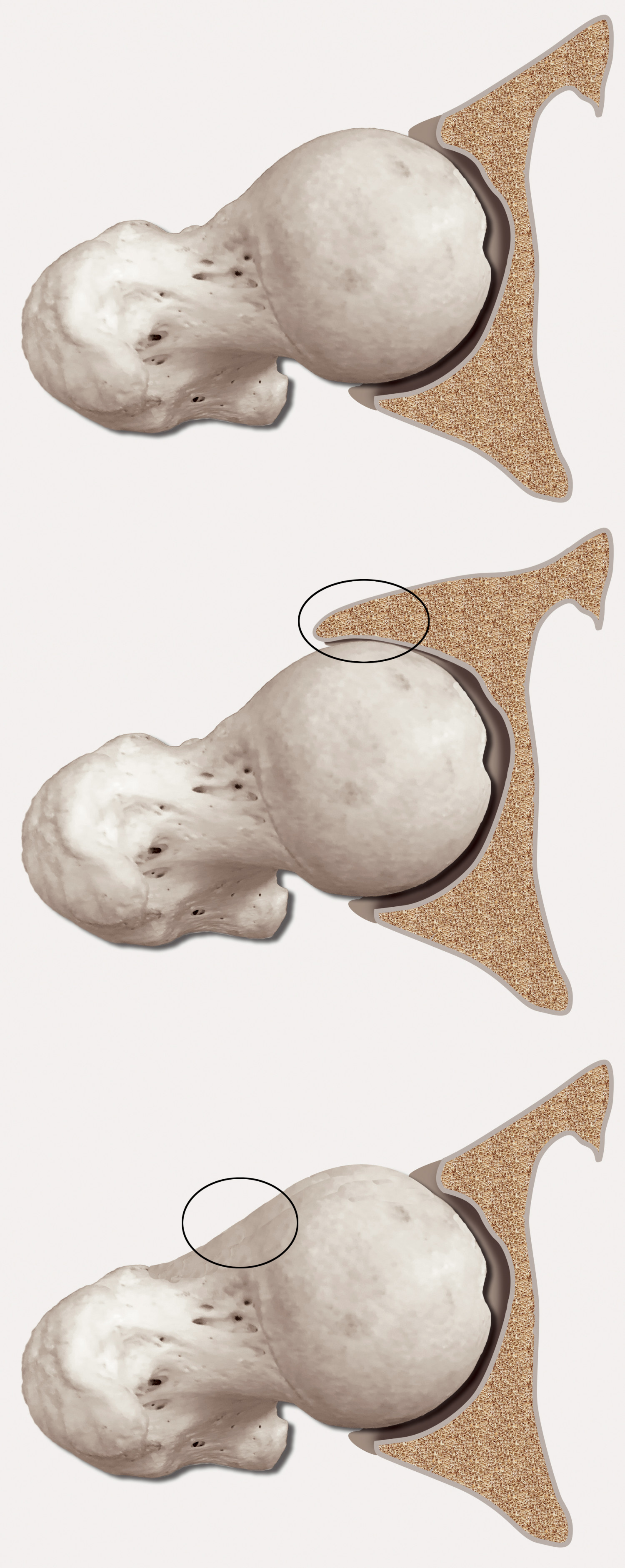 Figur 1 Femoroacetabular inneklemming (femoroacetabular impingement, FAI) er morfologiske forandringer med beinp&aring;leiringer&hellip;
