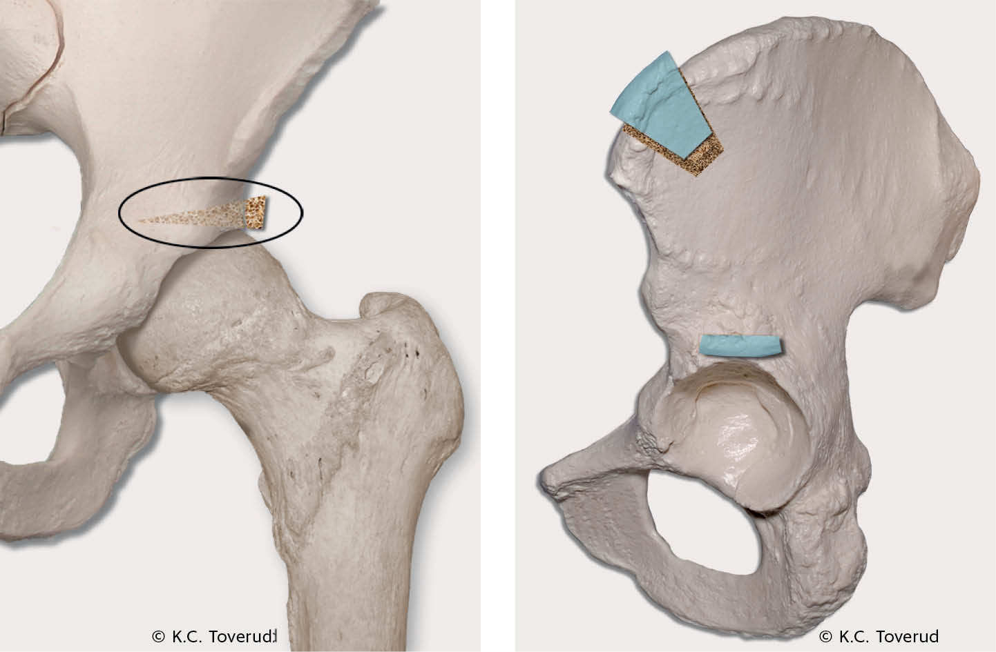 Figur 2 Ved Spitzys prosedyre tas det et beintransplantat fra ileum som settes inn over acetabulumtaket slik at&hellip;