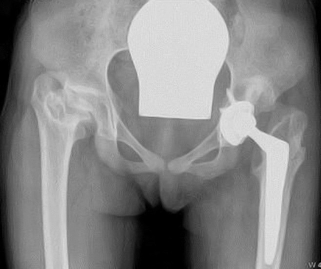 Figur 4 Eksempel p&aring; alvorlig sekvele etter neonatal sepsis med bilaterale hofteinfeksjoner. R&oslash;ntgen av bekken tatt da&hellip;