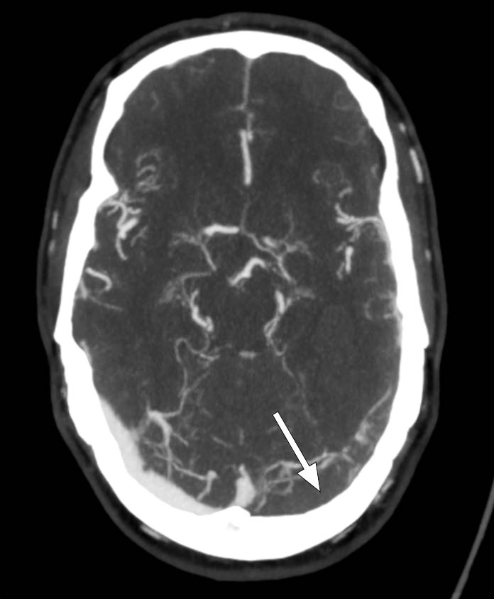 Figur 2 Aksial kontrastforsterket CT-venografi viser manglende kontrastfylning i venstre sinus transversus (pil), forenlig&hellip;