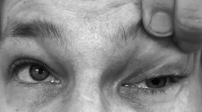 Figur 1 Anisokori og ekstraokul&aelig;r oftalmoplegi.