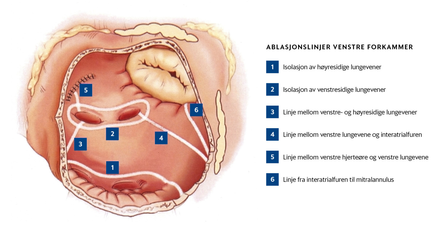 Figur 1  Ablasjonslinjer etter CURE-AF-protokollen generert med radiofrekvensablasjon. Figur er gjengitt etter tillatelse&hellip;