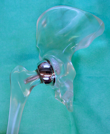 Figur 1 En Birmingham hip resurfacing-skallprotese (Smith and Nephew, Warwick, England), her satt inn i en hoftemodell, har&hellip;