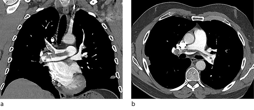 Figur 1 Koronale (a) og aksiale (b) snitt p&aring; pulmonal CT-angiografi viser utbredt lungeembolisme i truncus pulmonalis samt&hellip;