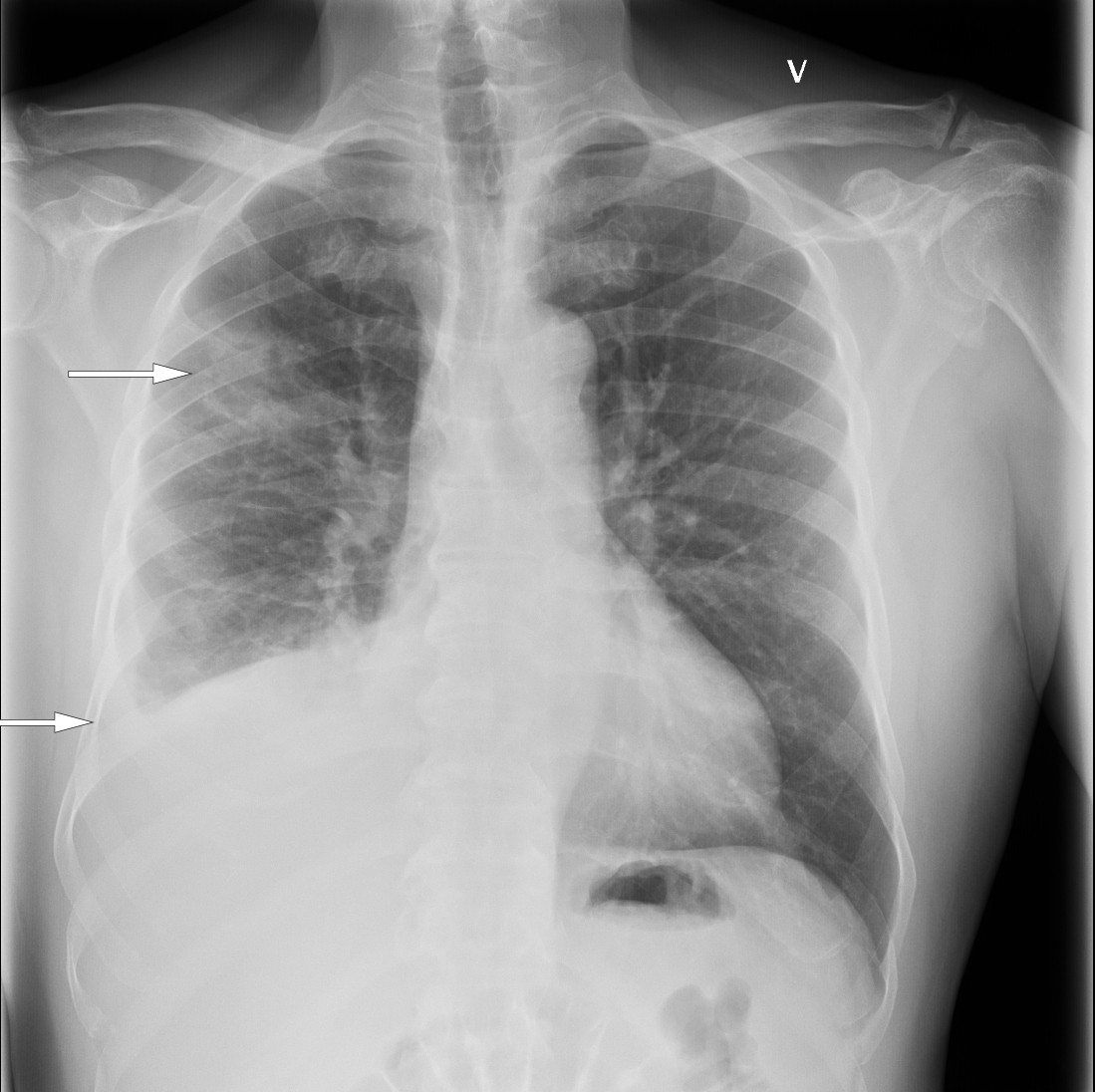 Figur 1 R&oslash;ntgen thorax viste h&oslash;yresidig pleurav&aelig;ske og fortetninger i h&oslash;yre lunges overlapp.