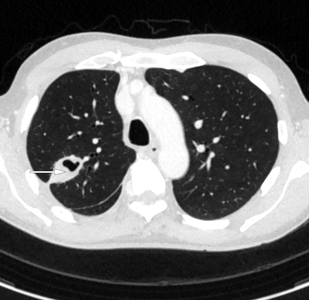 Figur 3 CT thorax med intraven&oslash;s kontrast viste en kaverne basalt i h&oslash;yre lunges overlapp.