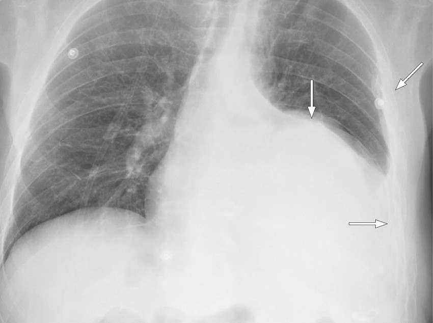 Figur 1 R&oslash;ntgen thorax viser multiple ribbeinsbrudd og en stor ansamling pleurav&aelig;ske p&aring; venstre side.