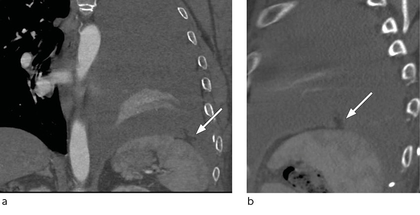 Figur 2 CT thorax med intraven&oslash;s kontrast og koronal (a) og sagittal (b) rekonstruksjon viser en liten defekt i venstre&hellip;