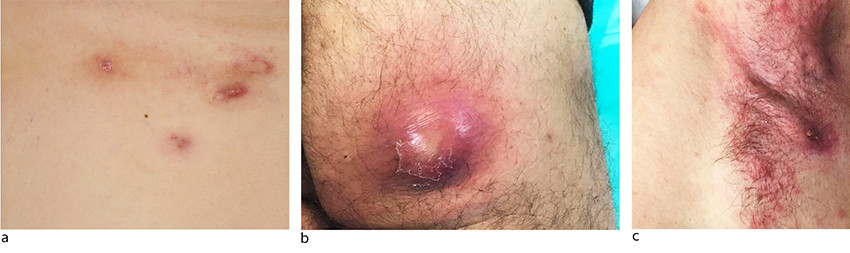 Figur 1 Eksempler p&aring; typiske lesjoner ved hidrosadenitt: inflammatoriske noduli (a), abscess (b) og sinus/sinusganger (c).