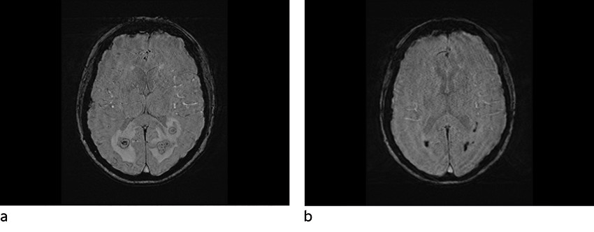 Figur 2 Susceptibilitetsvektet sekvens. a) F&oslash;r behandling: signalbortfall i periferien samt i sm&aring; foci sentralt. b) Etter&hellip;
