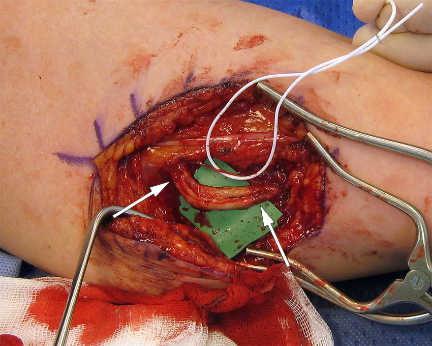 Figur 1 Operasjonsbilde, mediale overarm. En liten fasikkel av ulnarisnerven var intakt (holdes til side med hvit strikk),&hellip;