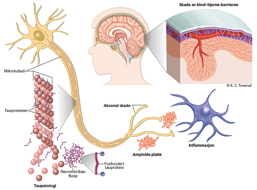 Figur 1 Skjematisk fremstilling av de vanligste nevropatologiske forandringene ved Alzheimers sykdom, med ekstracellul&aelig;r&hellip;
