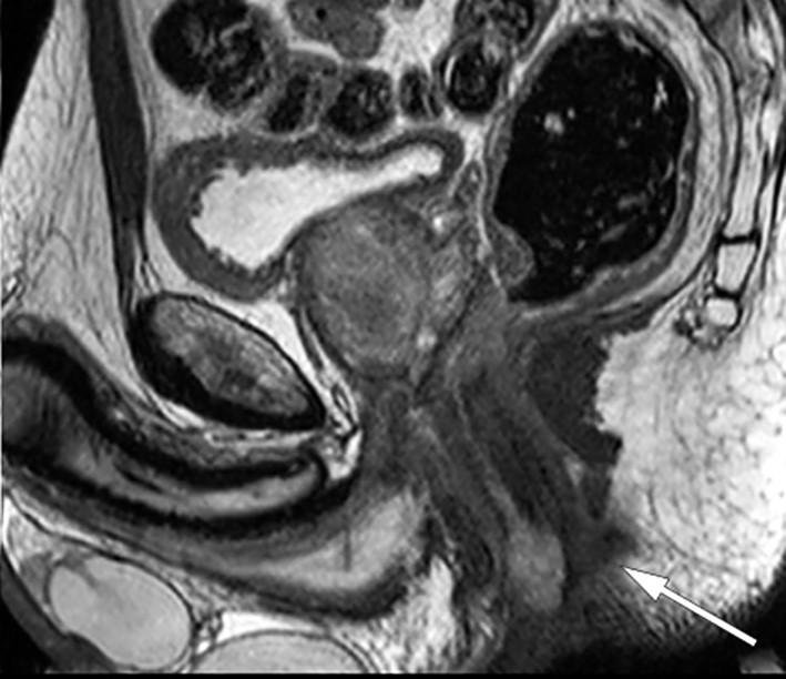 Figur 1 MR-bilde, sagittalsnitt av bekken. Tumor i nedre analkanal (pil).