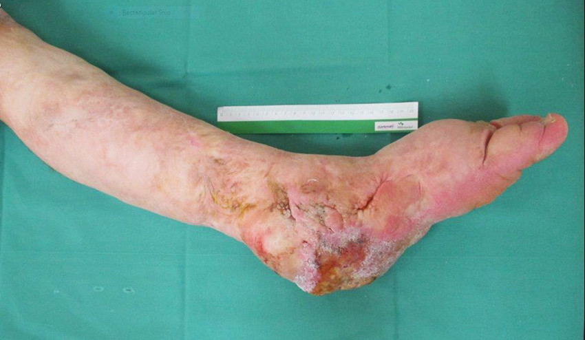 Figur 1 Venstre legg og fot sett medialt ved f&oslash;rste konsultasjon. Uttalte arrforandringer etter omfattende tidligere kirurgi&hellip;