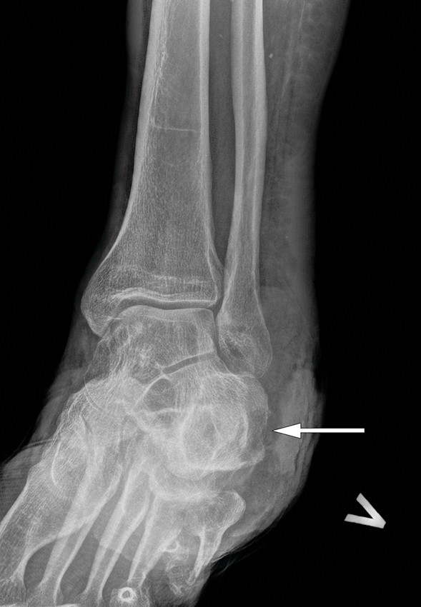 Figur 3 R&oslash;ntgenbilde av venstre fot og ankel. Pilen peker mot osteolysen i kalkaneus.