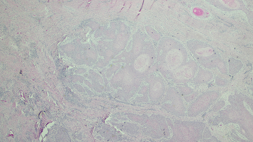 Figur 5 Rutinefarget histologisk snitt (HE) fra tumor viser atypisk endofytisk vekst av h&oslash;yt differensiert plateepitel,&hellip;