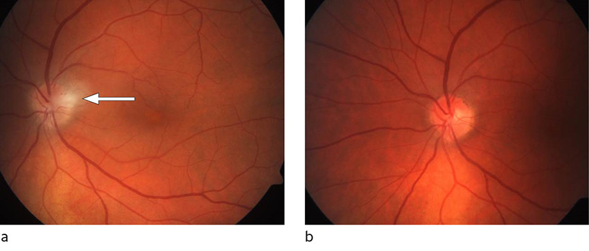 Figur 1 Fundusfoto av pasientens venstre &oslash;ye ved diagnosetidspunktet (a) og etter seks ukers behandling (b). Den hvite pilen&hellip;