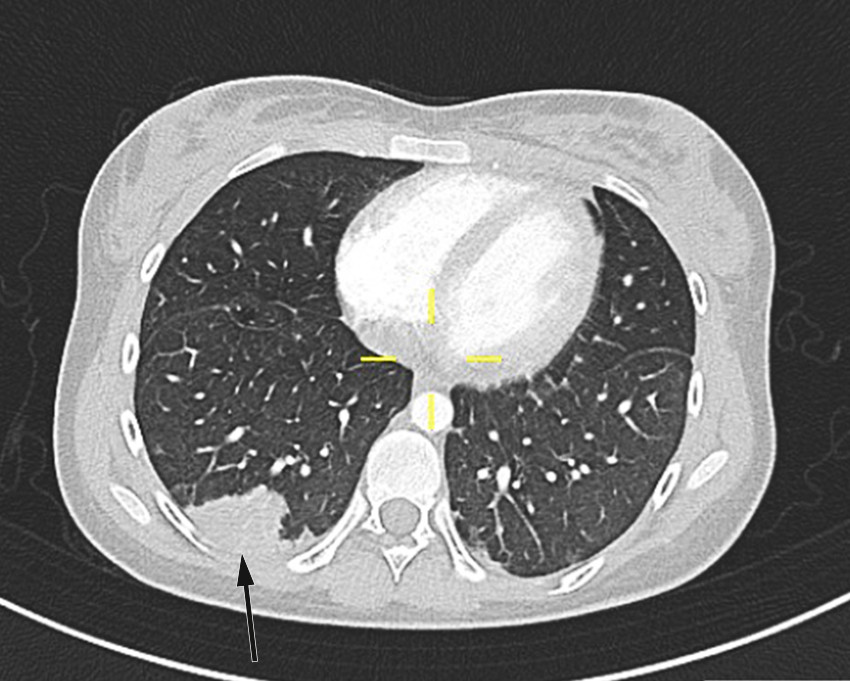 Figur 3 CT-bilder av pasientens lunger tatt p&aring; andre innleggelsesdag. Bildet viser et infarkt i h&oslash;yre underlapp. Sannsynlig&hellip;