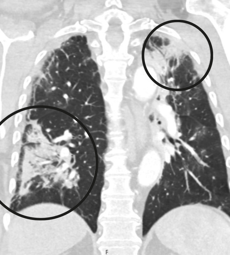 Figure 2 Pulmonary opacities with partial consolidation and ground-glass appearance.
