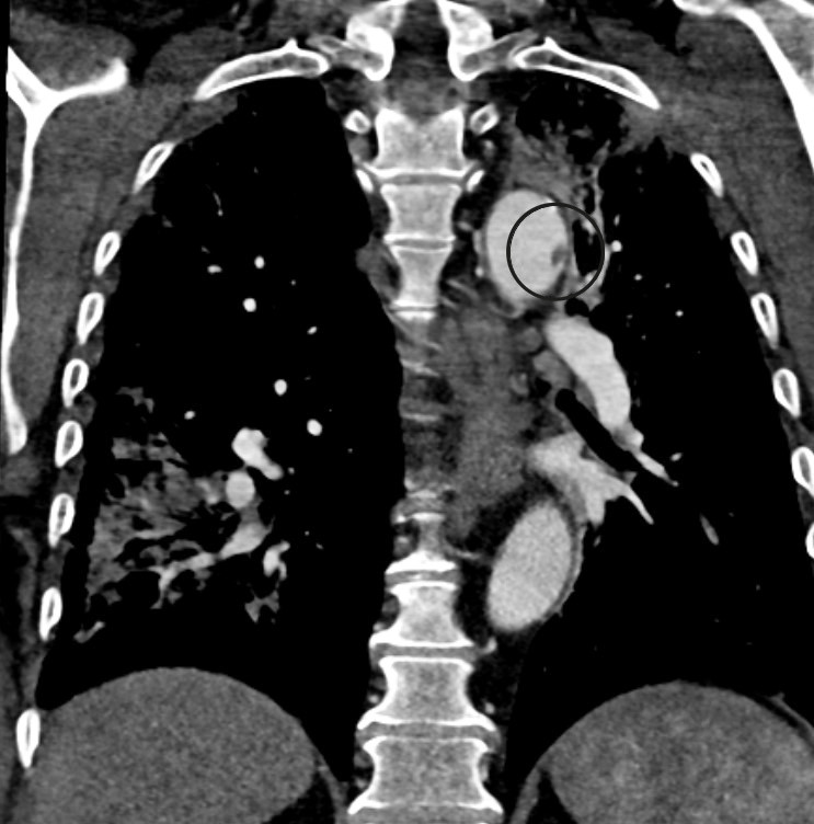 Figure 3 Floating thrombus in the aortic arch.