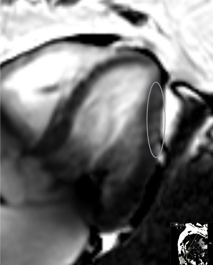 Figur 1 MR hjerte i kortakse- og firekammerplan fremstiller forsinket kontrastoppladning subepikardielt (aktuelle omr&aring;de er&hellip;