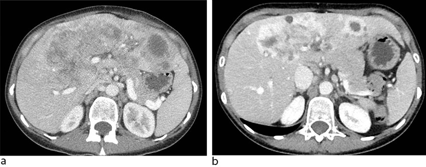Figur 1 CT f&oslash;r (a) og fem uker etter oppstart (b) av behandling.