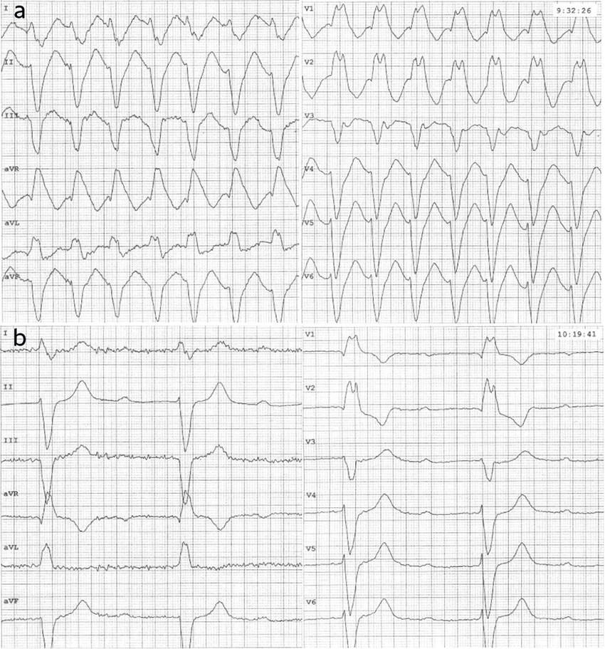Figure 1 ECG taken at 50 minute intervals, showing the patient's fluctuating heart rhythm. Paper speed 50 mm/s. The times&hellip;