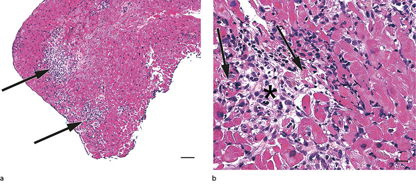 Figur 2 Hematoksylin-eosin- og safranfarget snitt fra hjertebiopsien. a) Her ses flekkvise betennelsesinfiltrater (piler) i&hellip;