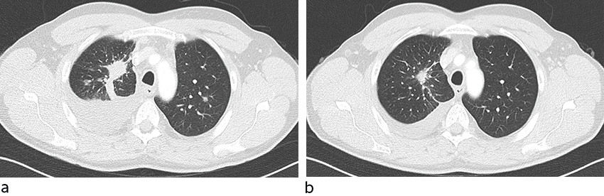 Figur 2 a) CT toraks tatt rett f&oslash;r oppstart RET-hemmer. b) CT toraks etter &aring;tte ukers behandling viste tilbakegang av&hellip;
