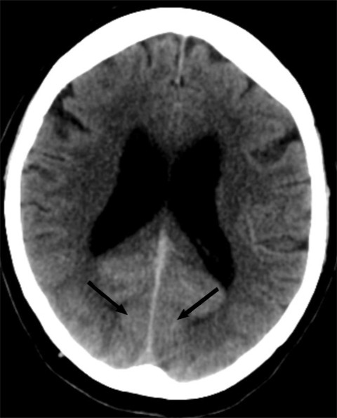 Figure 1 Brain CT shows widespread diffuse contrast retention in occipital regions bilaterally, including visual cortex, but&hellip;