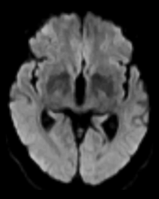 Figur 2 					MR caput viser ingen diffusjonsforandringer.				