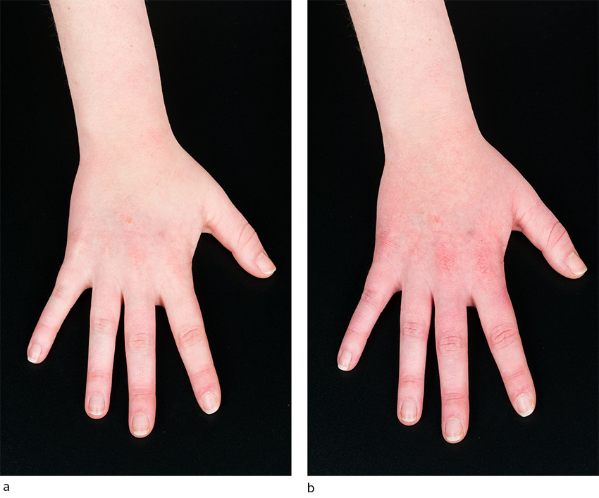 Figure 1 Patient's hand before (a) and after (b) wearing a glove. An urticarial reaction occurred shortly after the glove&hellip;