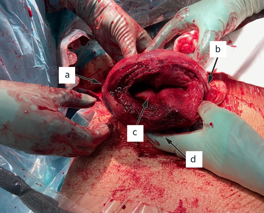 Figure 2 Large uterine rupture extending from right (a) to left (b) tubal corner into the uterine cavity (c). The uterotomy&hellip;