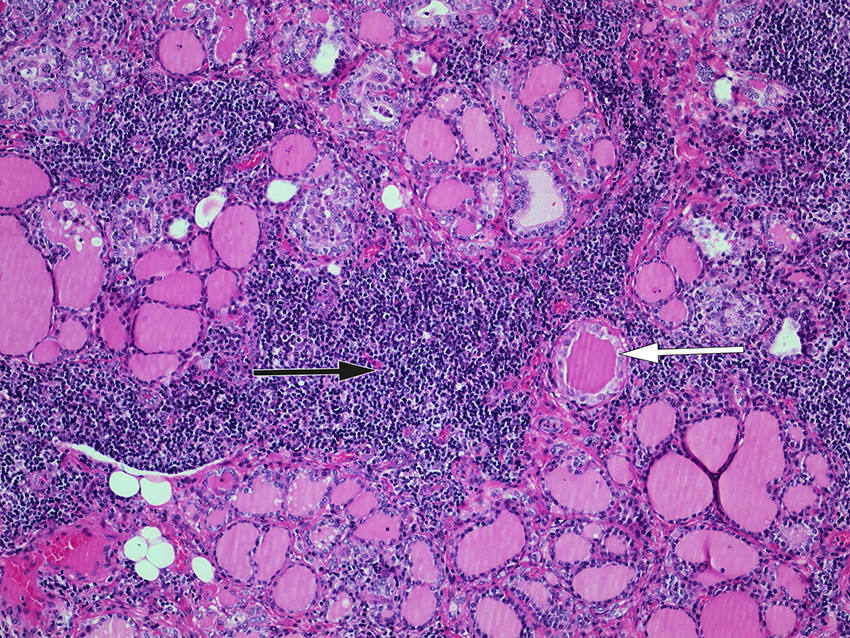 Figure 1 Histological section of tissue specimen from left thyroid lobe. The image shows pronounced chronic lymphocytic&hellip;