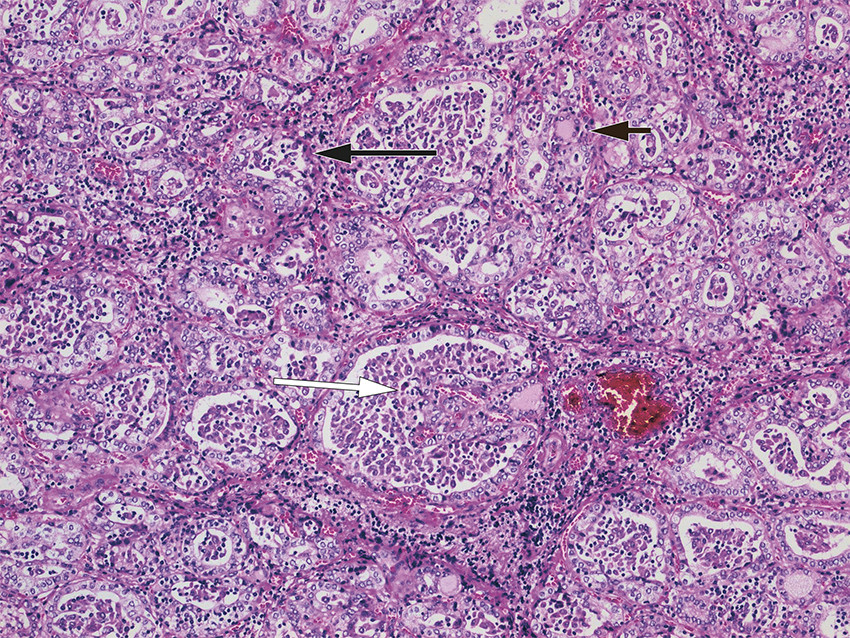 Figur 2 Histologisnitt av operasjonspreparat fra h&oslash;yre tyreoidealapp. Bildet viser utbredte forandringer i form av&hellip;